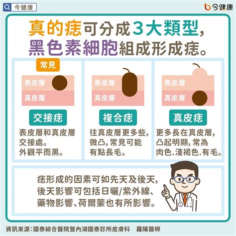 長痣原因|痣是什麼？一次了解痣原因、就醫時機以及如何改善